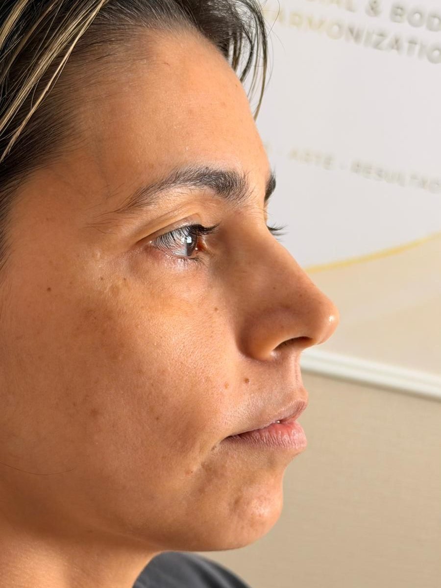 Antes — Harmonização Facial