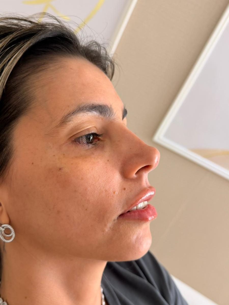 Resultado de harmonização facial