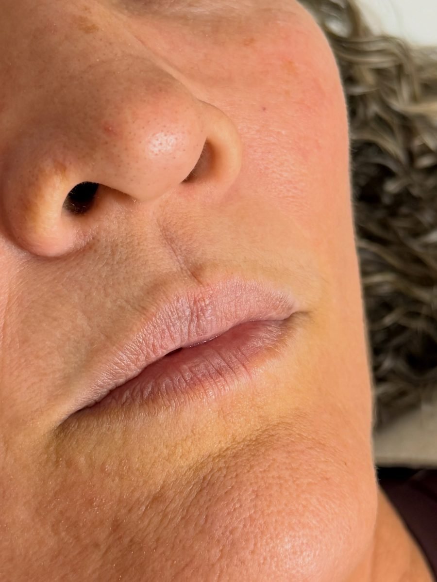Antes — Preenchimento Labial