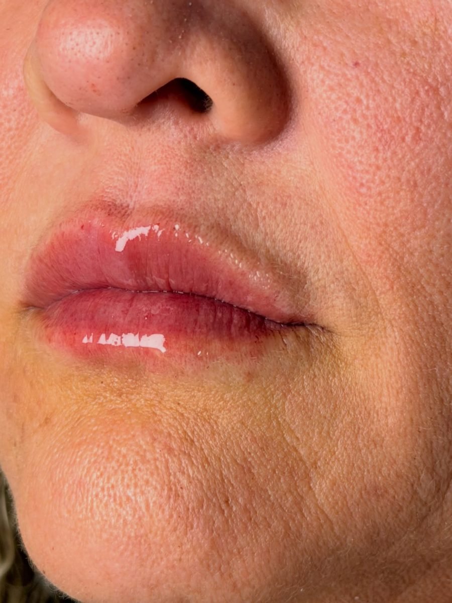 Resultado de preenchimento labial